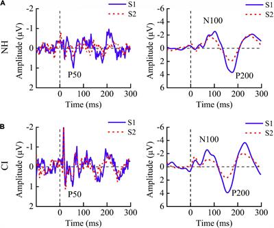 Auditory Sensory Gating in Children With Cochlear Implants: A P50-N100-P200 Study